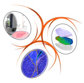 H2i   Hépatocarcinome, immunité et inflammation